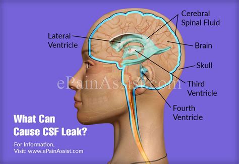 csf yellow fluid leaking from nose|CSF leak (Cerebrospinal fluid leak)